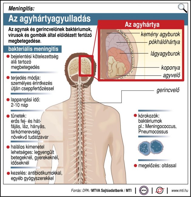 Meningitis: Az agyhártyagyulladás jellemzői (Forrás: MTVA)