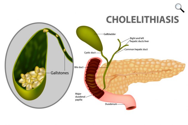 Epekövesség (cholelithiasis) - az epehólyagban bizonyítható a kő kialakulása (Fotó: Vectorstock)