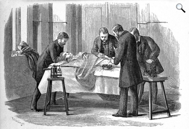 Joseph Lister (1827-1902) brit sebész, az antiszeptikus sebészet úttörője fenolt permetez műtét közben, 1882 (Fotó: Wikimédia)